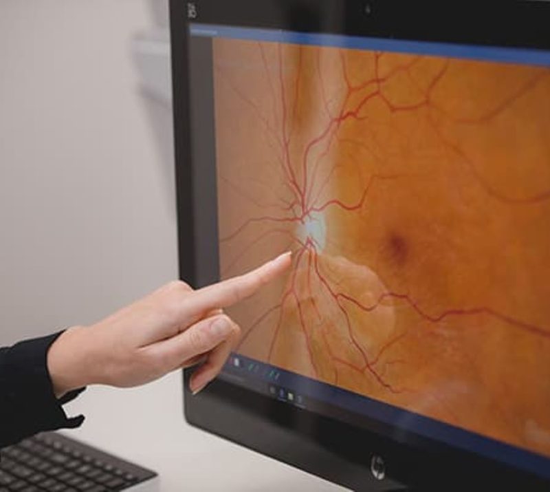 Macular Degeneration treatment at Eye Care Ltd